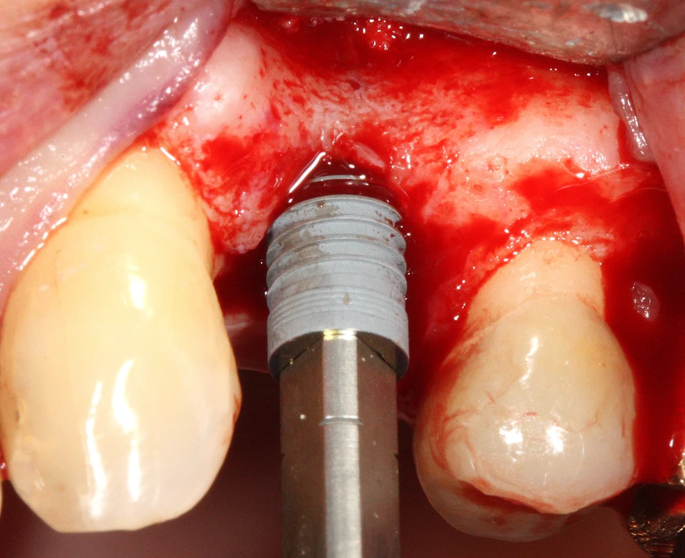 Etape chirurgicale de la pose d'un implant dentaire dans la machoire