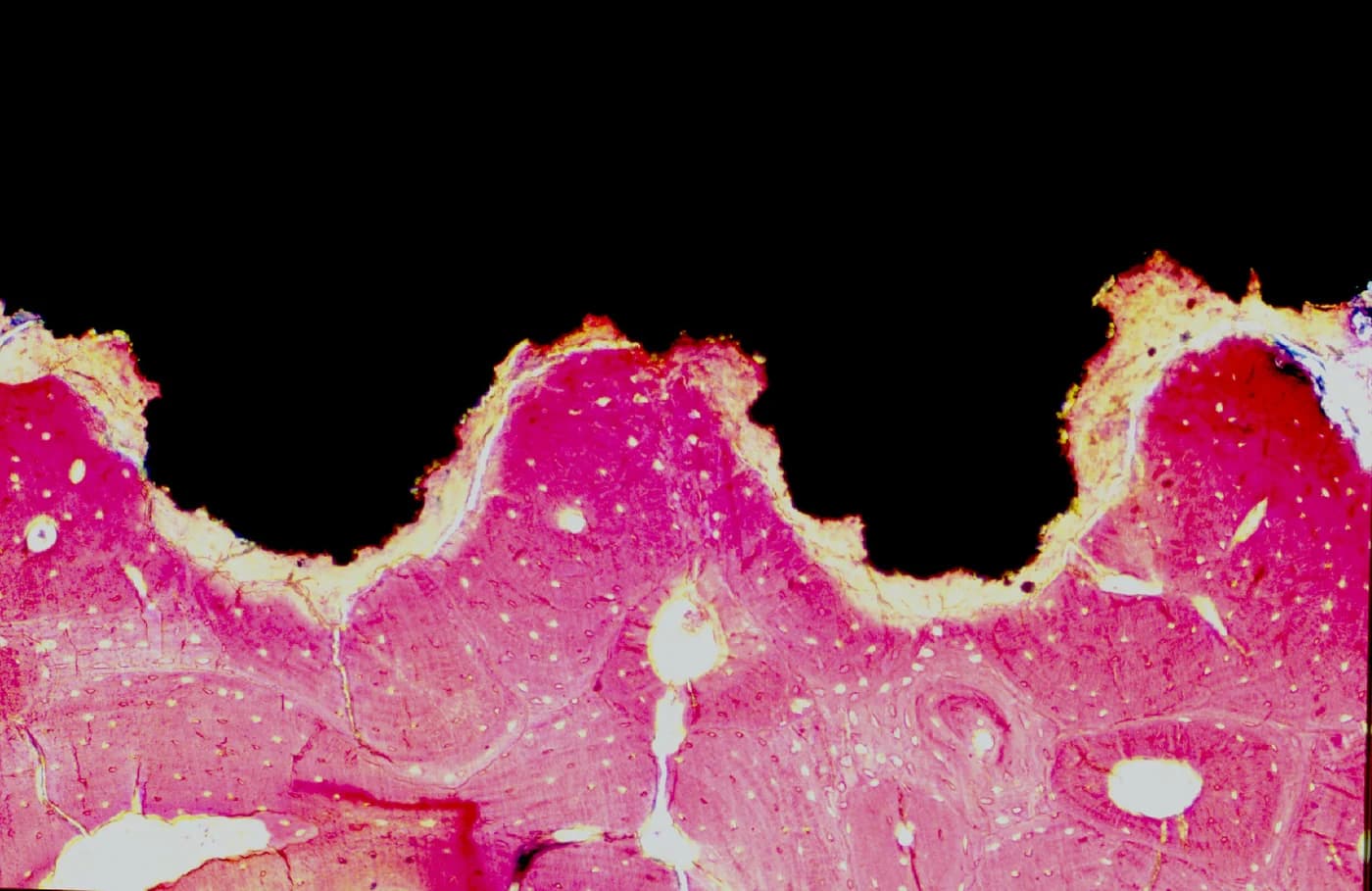 Coupe histologique montrant l'osseointegration, contact direct entre l'os vivant et la surface en titane d'un implant dentaire