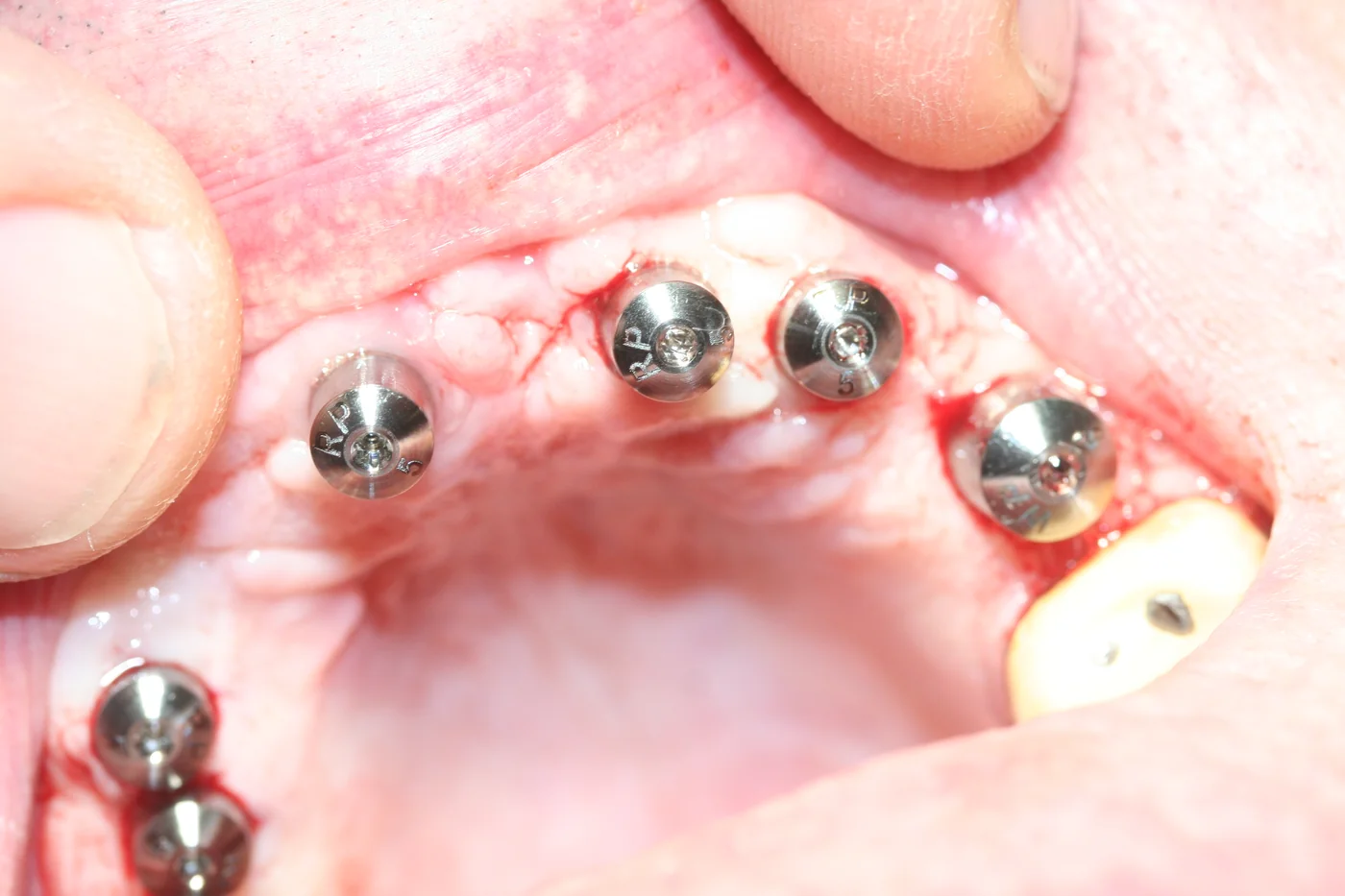 Bridge complet sur implants avec piliers de cicatrisation en place dans la bouche