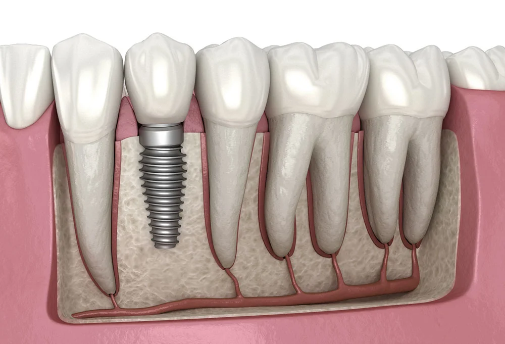 Schema anatomique d'un implant dentaire integre a la machoire avec pilier et couronne ceramique