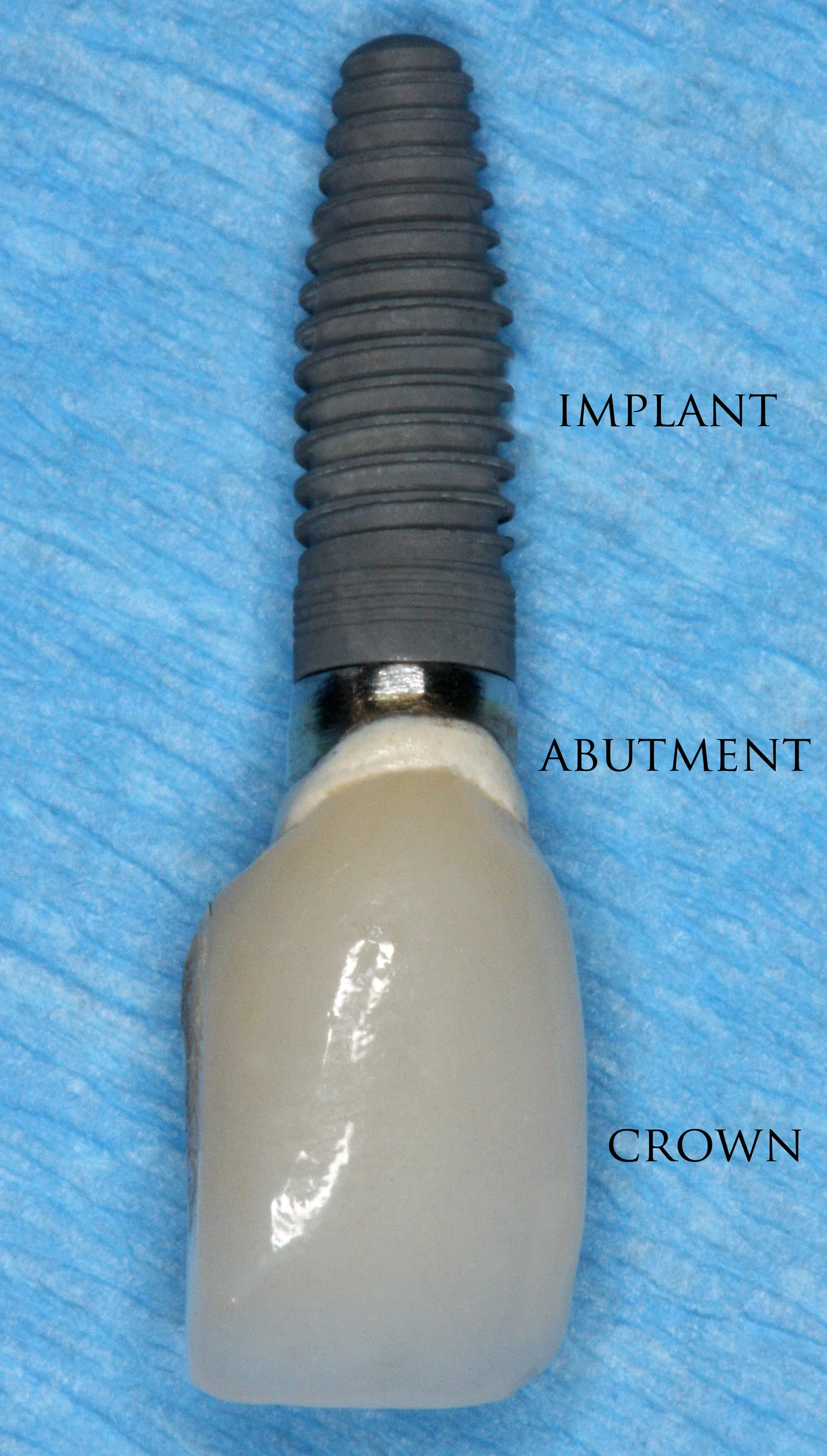 Photo clinique d'une couronne ceramique posee sur un implant dentaire unitaire